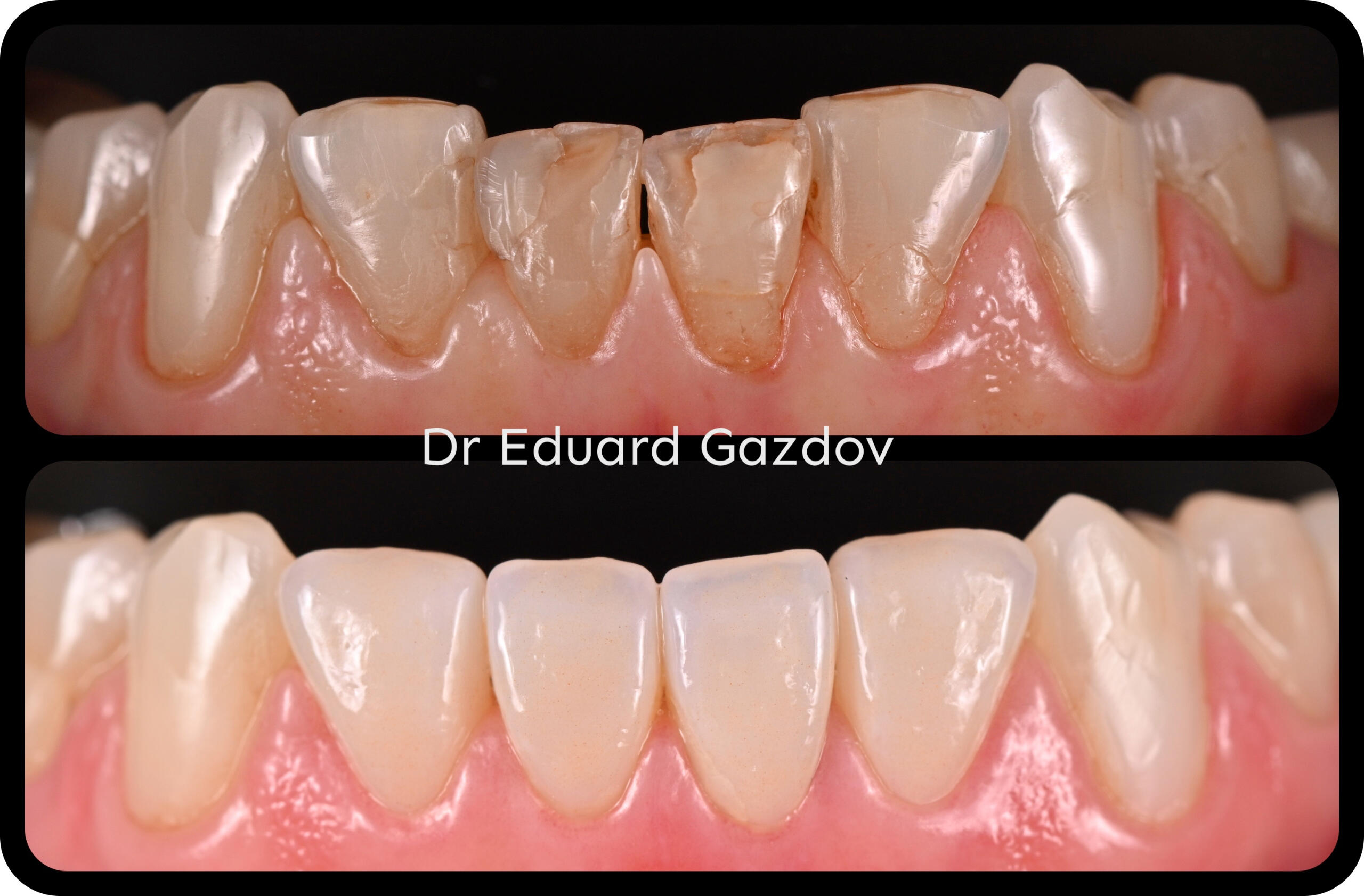 естествени порцеланови фасети винили