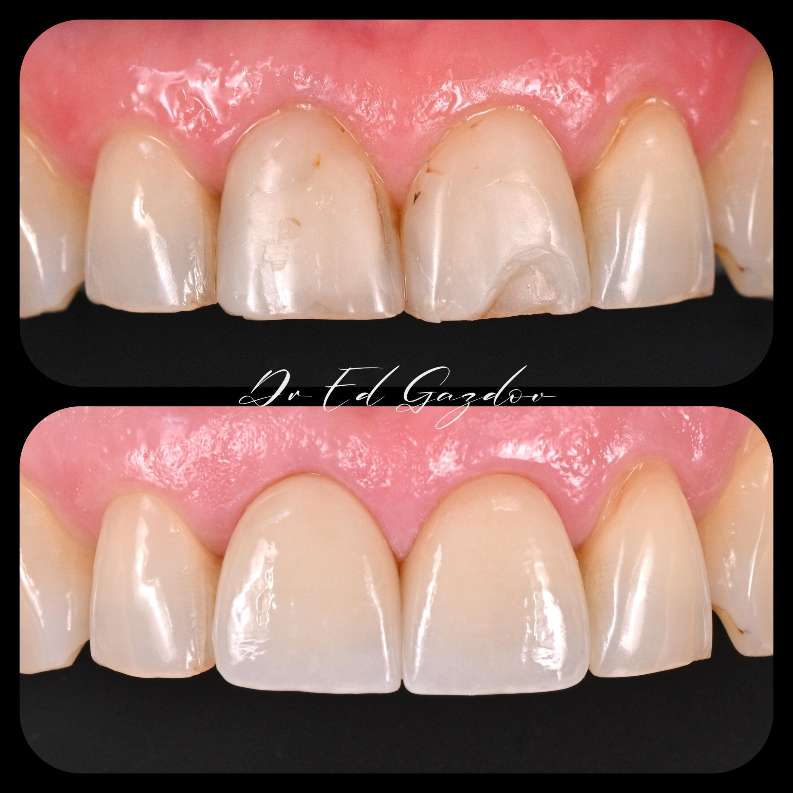 • alt="Cosmetic dental treatment in Bulgaria" • alt="Full smile rehabilitation with implants" • alt="Veneers and implants by Dr Eduard Gazdov" • alt="Dental implants before and after Sofia" винири, фасети