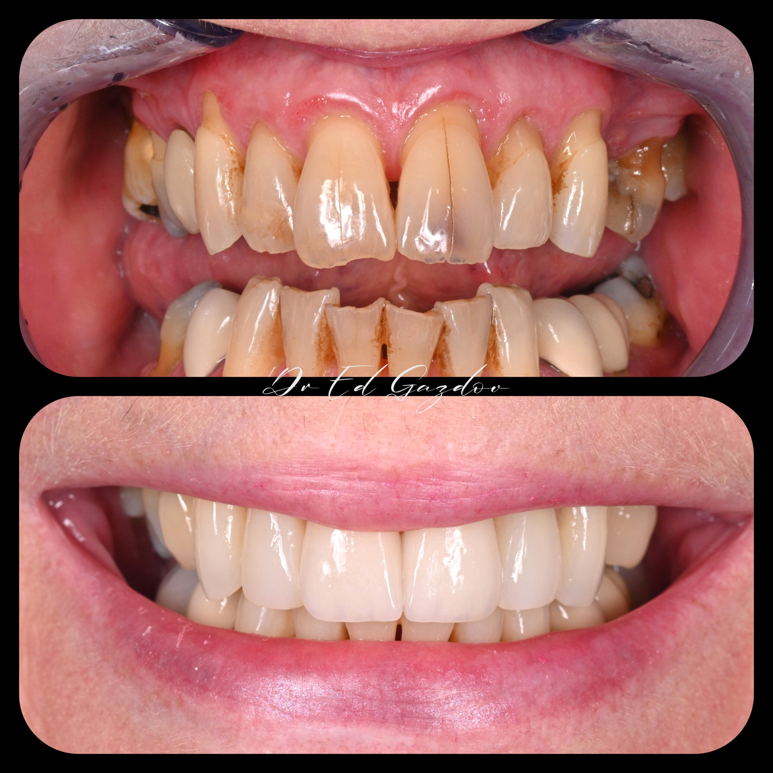• alt="Cosmetic dental treatment in Bulgaria" • alt="Full smile rehabilitation with implants" • alt="Veneers and implants by Dr Eduard Gazdov" • alt="Dental implants before and after Sofia" Фасети, винири