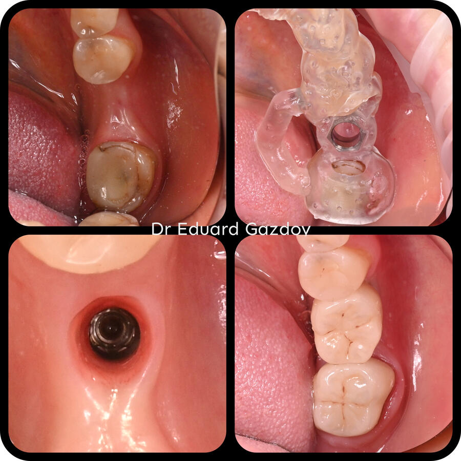 Имплант Dental Implant + crown