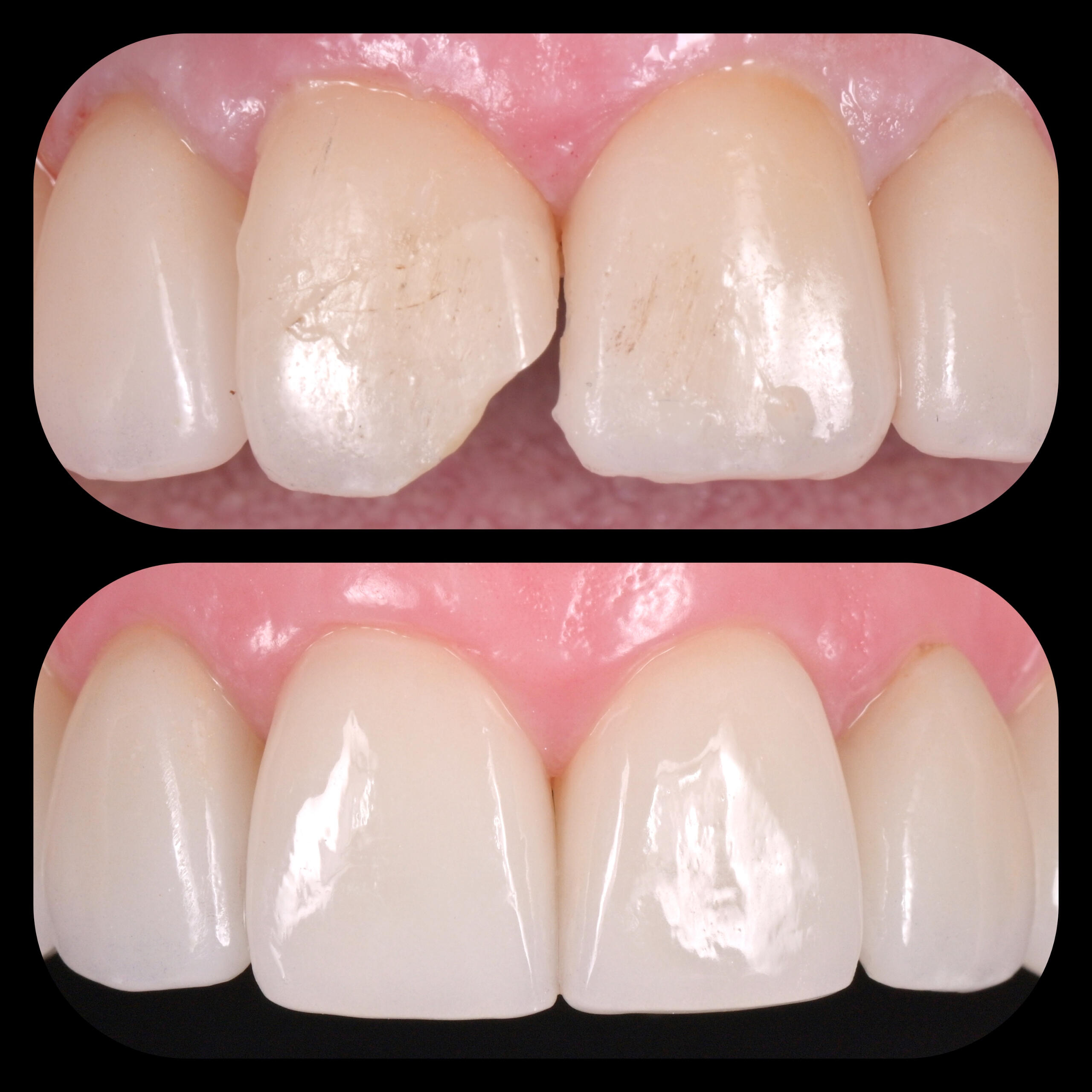 Faseti, винири, порцеланови корони