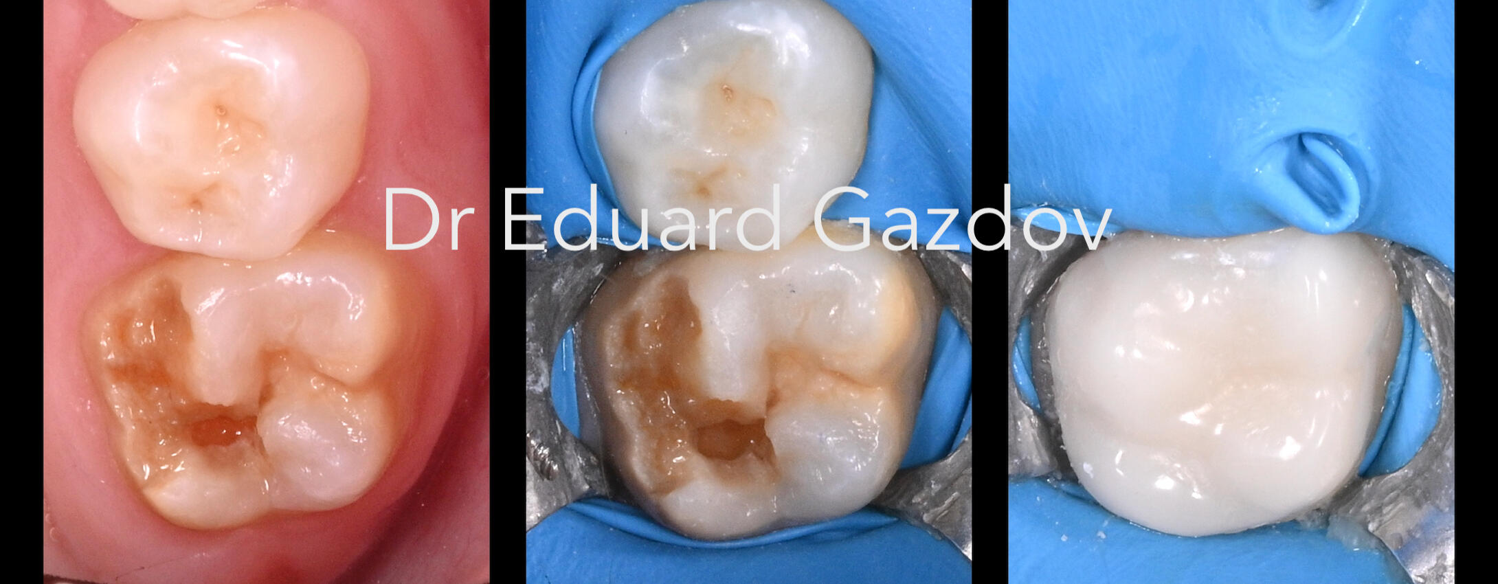 Композит бондинг корона