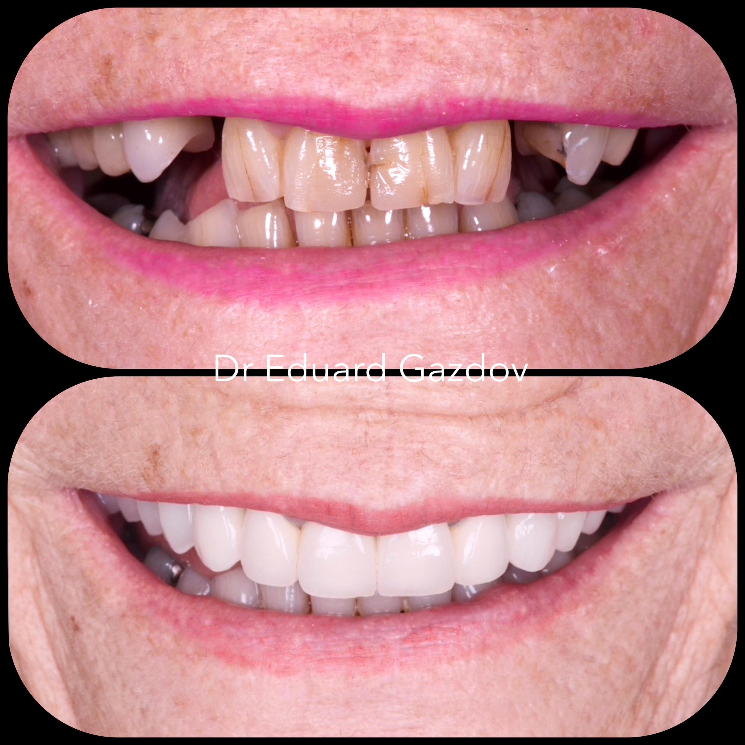 • alt="Cosmetic dental treatment in Bulgaria" • alt="Full smile rehabilitation with implants" • alt="Veneers and implants by Dr Eduard Gazdov" • alt="Dental implants before and after Sofia"