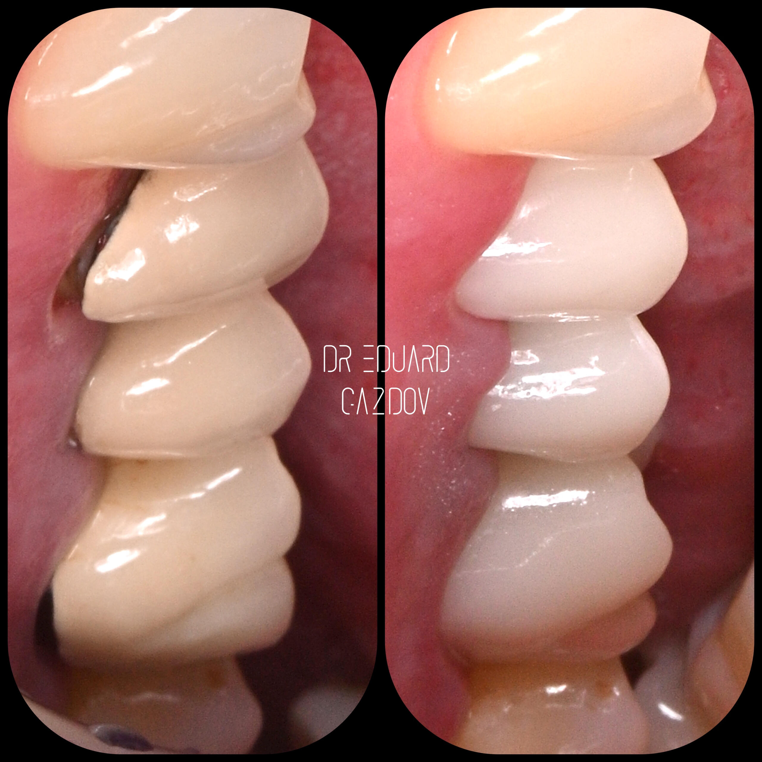 Before and after smile makeover with replacement of old crowns with dark margins using zirconia and porcelain crowns Single-visit ceramic crown created and fitted with digital CEREC system
