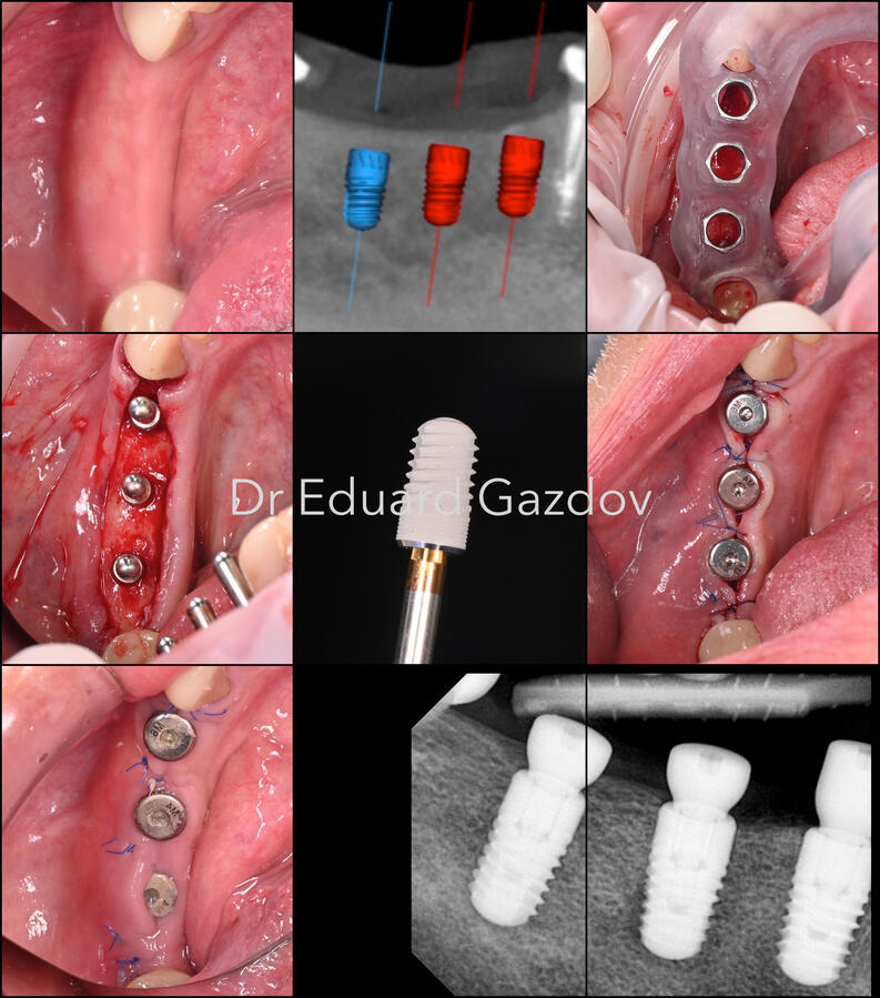 „Колаж, показващ етапите от поставяне на зъбен имплант чрез дигитално планиране и насочена хирургия.“