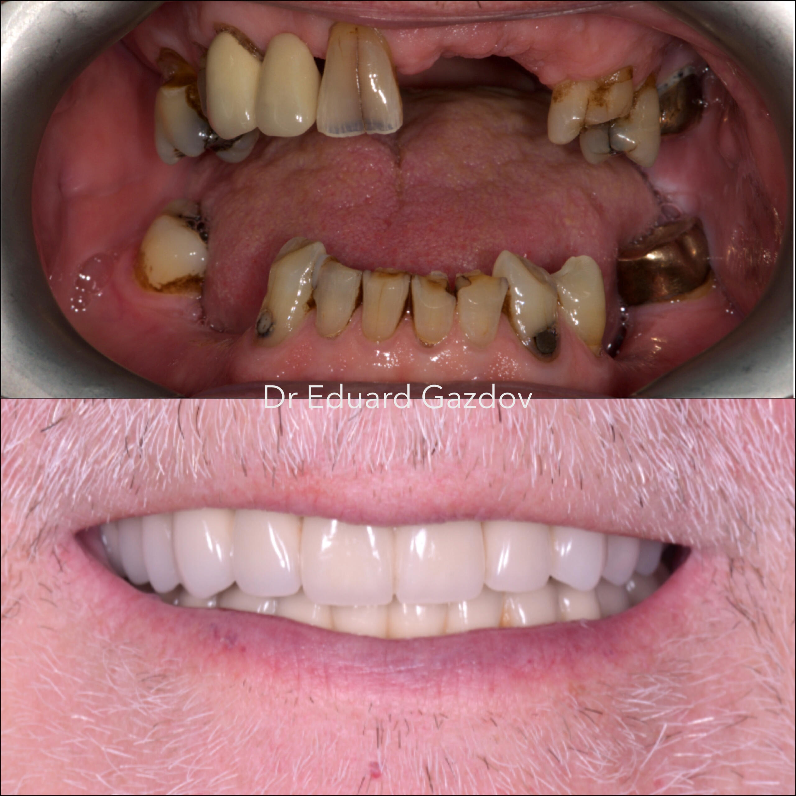• alt="Cosmetic dental treatment in Bulgaria" • alt="Full smile rehabilitation with implants" • alt="Veneers and implants by Dr Eduard Gazdov" • alt="Dental implants before and after Sofia