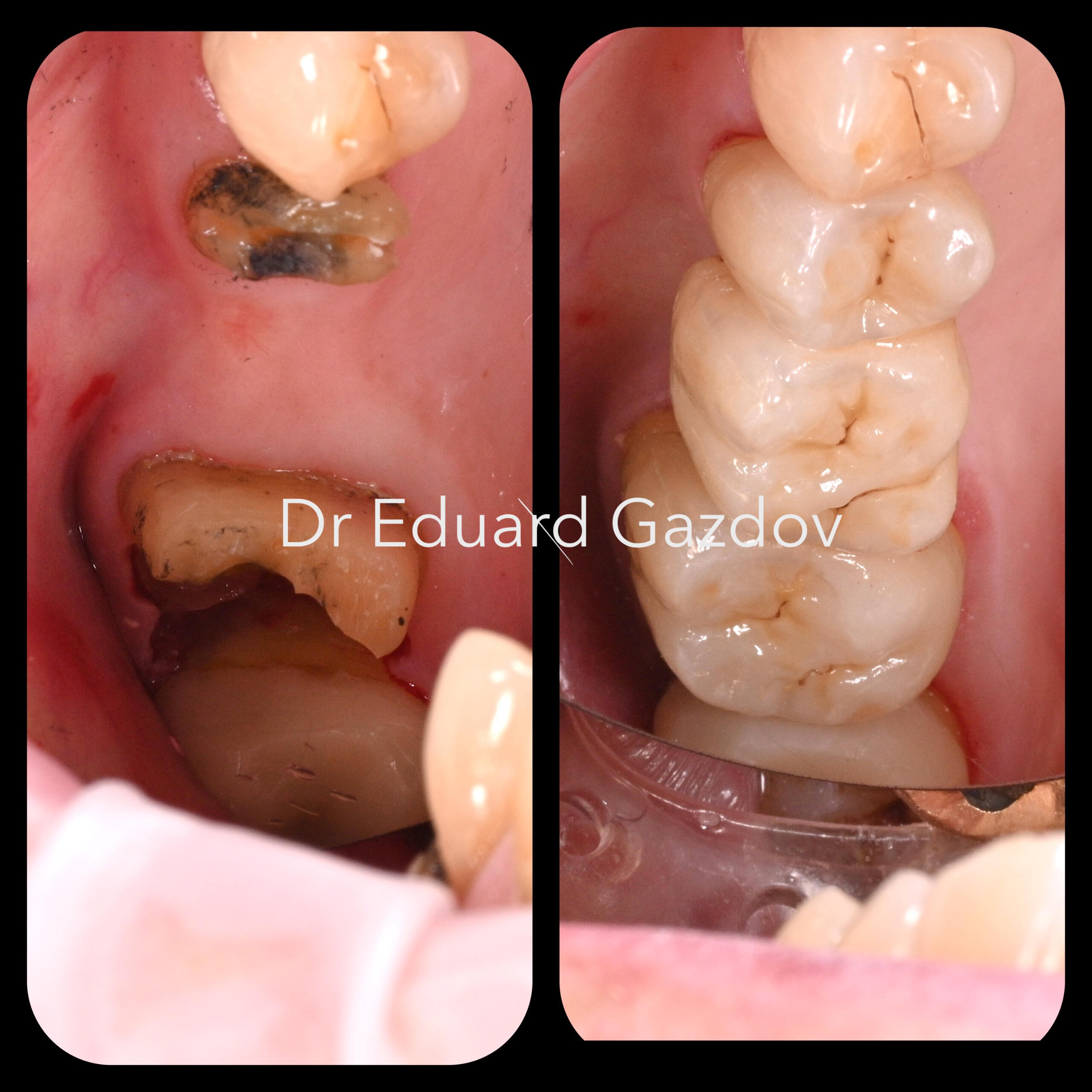 Фиксиран мост за заместване на липсващи зъби с естествена естетика