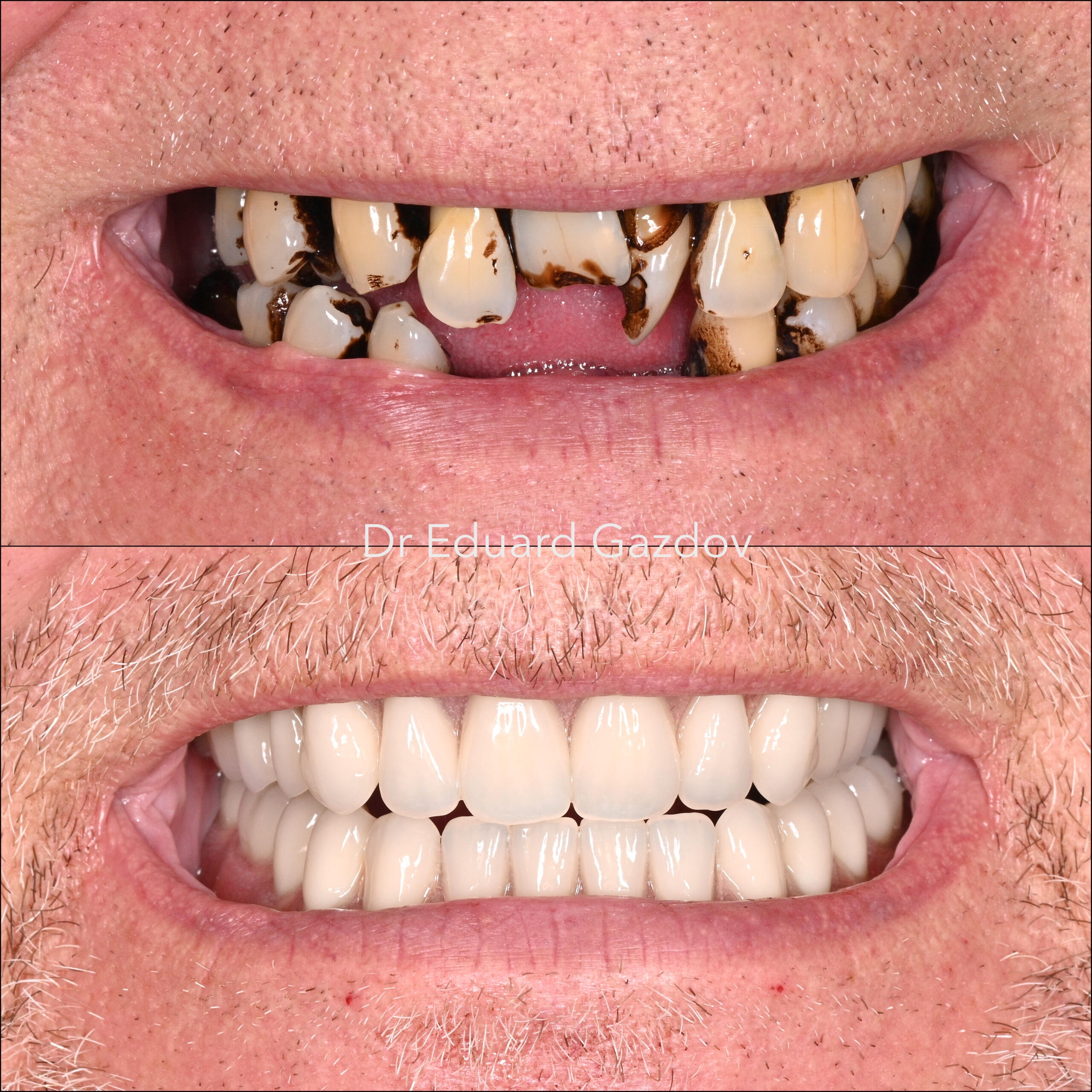 • alt="Cosmetic dental treatment in Bulgaria" • alt="Full smile rehabilitation with implants" • alt="Veneers and implants by Dr Eduard Gazdov" • alt="Dental implants before and after Sofia"