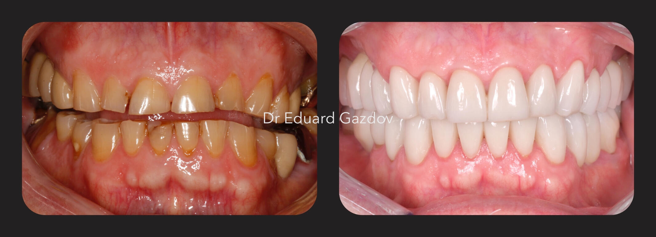 Before and after smile makeover with ceramic veneers for front teeth • alt="Cosmetic dental treatment in Bulgaria" • alt="Full smile rehabilitation with implants" • alt="Veneers and implants by Dr Eduard Gazdov" • alt="Dental implants before and after Sofi